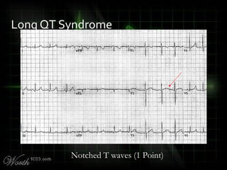 Long QT Syndrome
Notched T waves (1 Point)
 