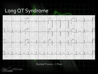 Long QT Syndrome
Notched T waves – 1 Point
 