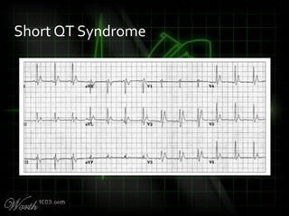Short QT Syndrome
 