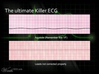 The ultimate Killer ECG
Asystole (Remember fine VF)
Leads not corrected properly
 