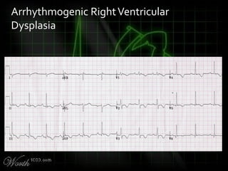 Arrhythmogenic RightVentricular
Dysplasia
 
