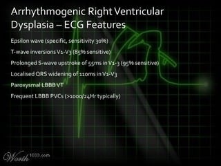 Epsilon wave (specific, sensitivity 30%)
T-wave inversionsV1-V3 (85% sensitive)
Prolonged S-wave upstroke of 55ms inV1-3 (95% sensitive)
Localised QRS widening of 110ms inV1-V3
Paroxysmal LBBBVT
Frequent LBBB PVCs (>1000/24Hr typically)
Arrhythmogenic RightVentricular
Dysplasia – ECG Features
 