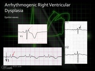 Epsilon waves
Arrhythmogenic RightVentricular
Dysplasia
 