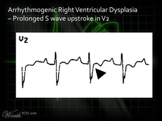 Arrhythmogenic RightVentricular Dysplasia
– Prolonged S wave upstroke inV2
 