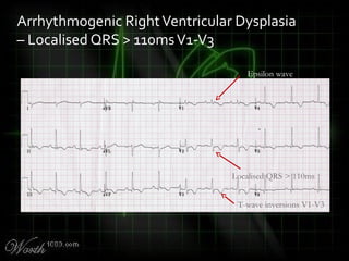 Arrhythmogenic RightVentricular Dysplasia
– Localised QRS > 110msV1-V3
Epsilon wave
Localised QRS > 110ms
T-wave inversions V1-V3
 