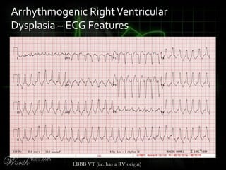 Arrhythmogenic RightVentricular
Dysplasia – ECG Features
LBBB VT (i.e. has a RV origin)
 