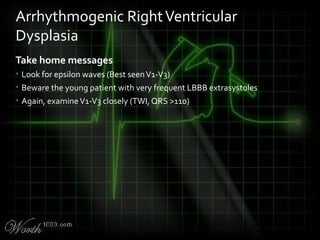 Take home messages
• Look for epsilon waves (Best seenV1-V3)
• Beware the young patient with very frequent LBBB extrasystoles
• Again, examineV1-V3 closely (TWI, QRS >110)
Arrhythmogenic RightVentricular
Dysplasia
 