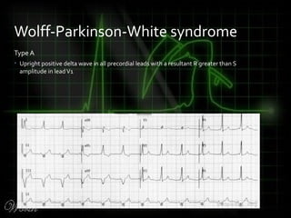 Type A
• Upright positive delta wave in all precordial leads with a resultant R greater than S
amplitude in leadV1
Wolff-Parkinson-White syndrome
 