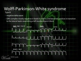 Type B
• negative delta wave
• QRS complex mostly negative in leadsV1 andV2 and becomes positive in transition
to the lateral leads resembling a left bundle-branch block
Wolff-Parkinson-White syndrome
 