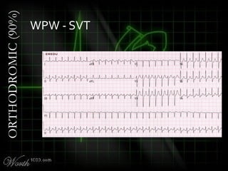 WPW - SVT
ORTHODROMIC(90%)
 