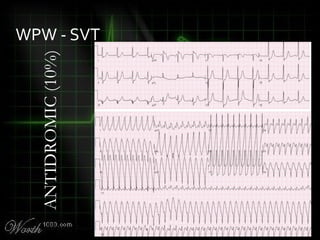 WPW - SVT
ANTIDROMIC(10%)
 