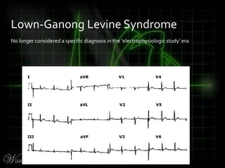 No longer considered a specific diagnosis in the ‘electrophysiologic study’ era
Lown-Ganong Levine Syndrome
 