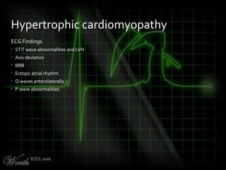 ECG Findings
• ST-T wave abnormalities and LVH
• Axis deviation
• BBB
• Ectopic atrial rhythm
• Q waves anterolaterally
• P wave abnormalities
Hypertrophic cardiomyopathy
 