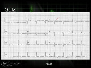 QUIZ
ARVD
 