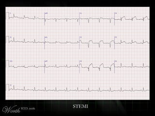 STEMI
 