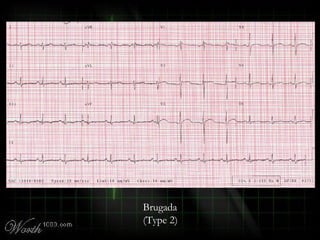 Brugada
(Type 2)
 