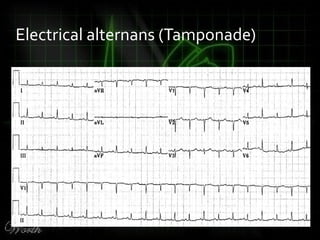 Electrical alternans (Tamponade)
 