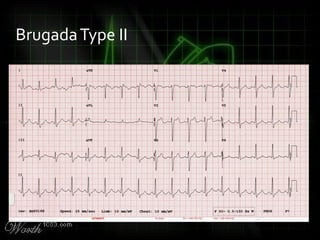 BrugadaType II
 