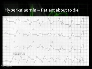 Hyperkalaemia – Patient about to die
 