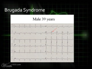 Brugada Syndrome
 