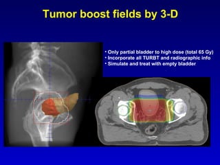 Bladder-Sparing Trimodality Therapy for Muscle-Invasive Bladder Cancer ...