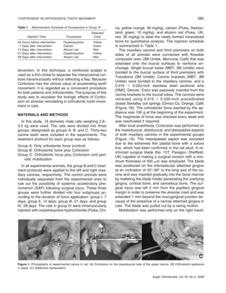 ‘‘CORTICISION’’ IN ORTHODONTIC TOOTH MOVEMENT
Table 1. Administration Schedule of Fluoresceins in Group IV
Injection Time
24
7
14
21
28

Hours before intervention
Days after intervention
Days after intervention
Days after intervention
Days after intervention

Fluorescein

Detected
Color

Oxytetracycline
Calcein
Alizarin red
Oxytetracycline
Alizarin red

Yellow
Green
Red
Yellow
Red

tervention. In this technique, a reinforced scalpel is
used as a thin chisel to separate the interproximal cortices transmucosally without reﬂecting a ﬂap. Because
Corticision has the clinical value of accelerating tooth
movement, it is regarded as a convenient procedure
for both patients and orthodontists. The purpose of this
study was to elucidate the biologic effects of Corticision on alveolar remodeling in orthodontic tooth movement in cats.
MATERIALS AND METHODS
In this study, 16 domestic male cats weighing 2.8–
3.5 kg were used. The cats were divided into three
groups, designated as groups A, B, and C. Thirty-two
canine teeth were included in the experiments. The
treatment protocol for each group was as follows:
Group A: Only orthodontic force (control)
Group B: Orthodontic force plus Corticision
Group C: Orthodontic force plus Corticision and periodic mobilization
In all experimental animals, the group B and C treatment protocols were applied to the left and right maxillary canines, respectively. The control animals were
individually separated from the experimental ones to
rule out the possibility of systemic acceleratory phenomenon (SAP) following surgical injury. These three
groups were further divided into four subgroups according to the duration of force application: group I, 7
days; group II, 14 days; group III, 21 days; and group
IV, 28 days. The cats in group IV were intramuscularly
injected with oxytetracycline hydrochloride (Fluka, Chi-

285
na; yellow orange; 30 mg/kg), calcein (Fluka, Switzerland; green; 10 mg/kg), and alizarin red (Fluka, UK;
red; 30 mg/kg) to label the newly formed mineralized
bone for quantitative analysis. The injection schedule
is summarized in Table 1.
The maxillary second and third premolars on both
sides of all animals were connected with ﬂowable
composite resin (3M Unitek, Monrovia, Calif) that was
extended onto the buccal surfaces to reinforce anchorage. Single buccal tubes (MBT, 3M Unitek) were
bonded to the buccal surface of third premolars with
Transbond (3M Unitek). Canine brackets (MBT, 3M
Unitek) were bonded to the maxillary canines, and a
0.016 ϫ 0.022-inch stainless steel sectional wire
(RMO, Denver, Colo) was passively inserted from the
canine brackets to the buccal tubes. The canines were
retracted using 0.010 ϫ 0.030-inch precalibrated
closed Sentalloy coil springs (Ormco Co, Orange, Calif)
(Figure 1B). The orthodontic force exerted by the appliance was 100 g at the beginning of the experiment.
The magnitude of force was checked every week and
was reactivated if required.
After local anesthesia, Corticision was performed on
the mesiobuccal, distobuccal, and distopalatal aspects
of both maxillary canines in the experimental groups
(Figure 1A). The mesiopalatal aspect was excluded
due to the extremely thin palatal bone with a suture
line, which had been conﬁrmed in the cat skull. A reinforced surgical blade (No. 15T, Paragon, Shefﬁeld,
UK) capable of making a surgical incision with a minimum thickness of 400 ␮m was employed. The blade
was positioned on the interradicular attached gingiva
at an inclination of 45Њ–60Њ to the long axis of the canine and was inserted gradually into the bone marrow
by malleting the blade holder penetrating the overlying
gingiva, cortical bone, and cancellous bone. The surgical injury was left 2 mm from the papillary gingival
margin in order to preserve the alveolar crest and was
extended 1 mm beyond the mucogingival junction because of the presence of a narrow attached gingiva in
cats. The blade was pulled out by a swing motion.
Mobilization was performed only on the right maxil-

Figure 1. Photographs of experimental canine in cat. (A) Corticision on the mesiobuccal side of the upper canine. (B) Orthodontic appliance
in place. (C) Additional manipulation.
Angle Orthodontist, Vol 79, No 2, 2009

 