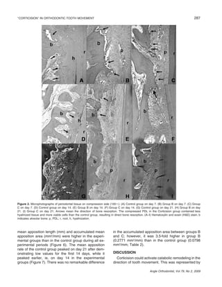 287

‘‘CORTICISION’’ IN ORTHODONTIC TOOTH MOVEMENT

Figure 2. Microphotographs of periodontal tissue on compression side (100ϫ): (A) Control group on day 7. (B) Group B on day 7. (C) Group
C on day 7. (D) Control group on day 14. (E) Group B on day 14. (F) Group C on day 14. (G) Control group on day 21. (H) Group B on day
21. (I) Group C on day 21. Arrows mean the direction of bone resorption. The compressed PDL in the Corticision group contained less
hyalinized tissue and more viable cells than the control group, resulting in direct bone resorption. (A–I) Hematoxylin and eosin (H&E) stain. b
indicates alveolar bone; p, PDL; r, root; h, hyalinization.

mean apposition length (mm) and accumulated mean
apposition area (mm2/mm) were higher in the experimental groups than in the control group during all experimental periods (Figure 6). The mean apposition
rate of the control group peaked on day 21 after demonstrating low values for the ﬁrst 14 days, while it
peaked earlier, ie, on day 14 in the experimental
groups (Figure 7). There was no remarkable difference

in the accumulated apposition area between groups B
and C; however, it was 3.5-fold higher in group B
(0.2771 mm2/mm) than in the control group (0.0798
mm2/mm; Table 2).
DISCUSSION
Corticision could activate catabolic remodeling in the
direction of tooth movement. This was represented by
Angle Orthodontist, Vol 79, No 2, 2009

 