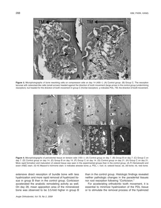288

KIM, PARK, KANG

Figure 3. Microphotographs of bone resorbing cells on compression side on day 14 (400ϫ): (A) Control group. (B) Group C. The resorption
lacunae with osteoclast-like cells (small arrows) headed against the direction of tooth movement (large arrow) in the control group (undermining
resorption), but headed for the direction of tooth movement in group C (frontal resorption). p indicates PDL; TM, the direction of tooth movement.

Figure 4. Microphotographs of periodontal tissue on tension side (100ϫ): (A) Control group on day 7. (B) Group B on day 7. (C) Group C on
day 7. (D) Control group on day 14. (E) Group B on day 14. (F) Group C on day 14. (G) Control group on day 21. (H) Group C on day 21.
More rapid formation and maturation of osteoid tissue was seen in the experimental groups than in the control group. (A–F) Hematoxylin and
eosin (H&E) stain. (G–H) Masson’s trichrome stain. b indicates alveolar bone; p, PDL; r, root; ot, osteoid tissue; ob, old bone; nb, new bone.

extensive direct resorption of bundle bone with less
hyalinization and more rapid removal of hyalinized tissue in group B than in the control group. Corticision
accelerated the anabolic remodeling activity as well.
On day 28, mean apposition area of the mineralized
bone was observed to be 3.5-fold higher in group B
Angle Orthodontist, Vol 79, No 2, 2009

than in the control group. Histologic ﬁndings revealed
neither pathologic changes in the paradental tissues
nor root resorption following ‘‘Corticision.’’
For accelerating orthodontic tooth movement, it is
essential to minimize hyalinization of the PDL tissue
or to stimulate the removal process of the hyalinized

 