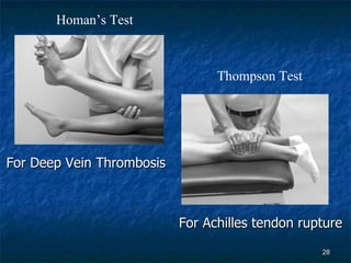 Homan’s Test Thompson Test For Achilles tendon rupture For Deep Vein Thrombosis 