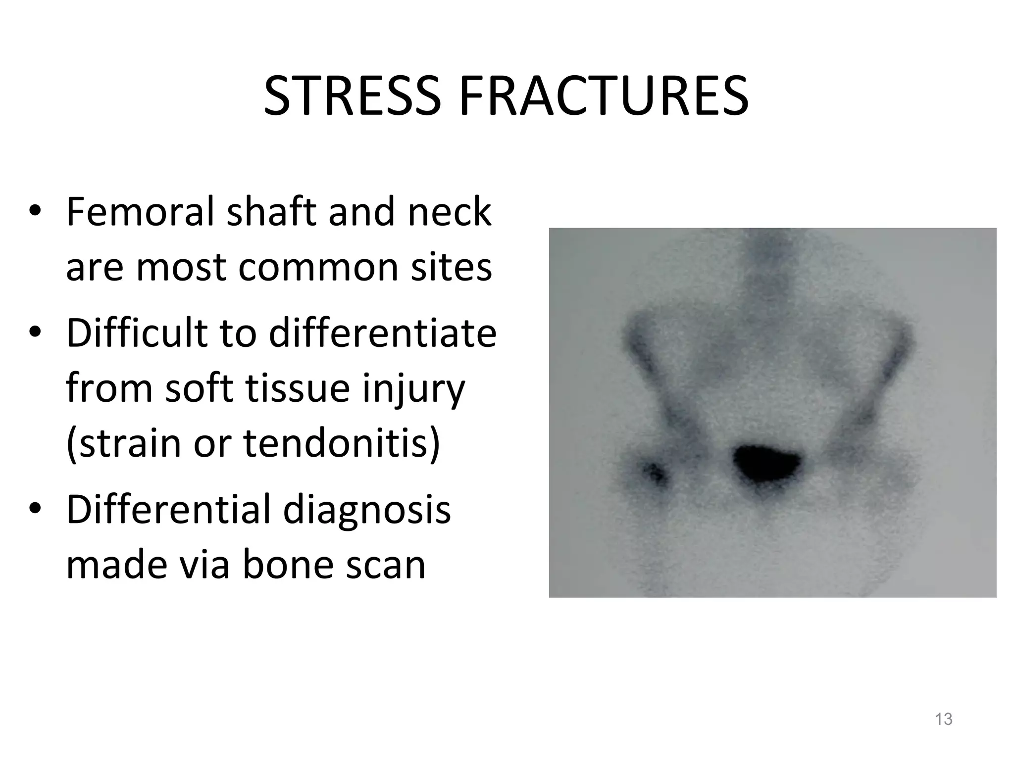 STRESS FRACTURES Femoral shaft and neck are most common sites Difficult to differentiate from soft tissue injury (strain or tendonitis) Differential diagnosis made via bone scan 