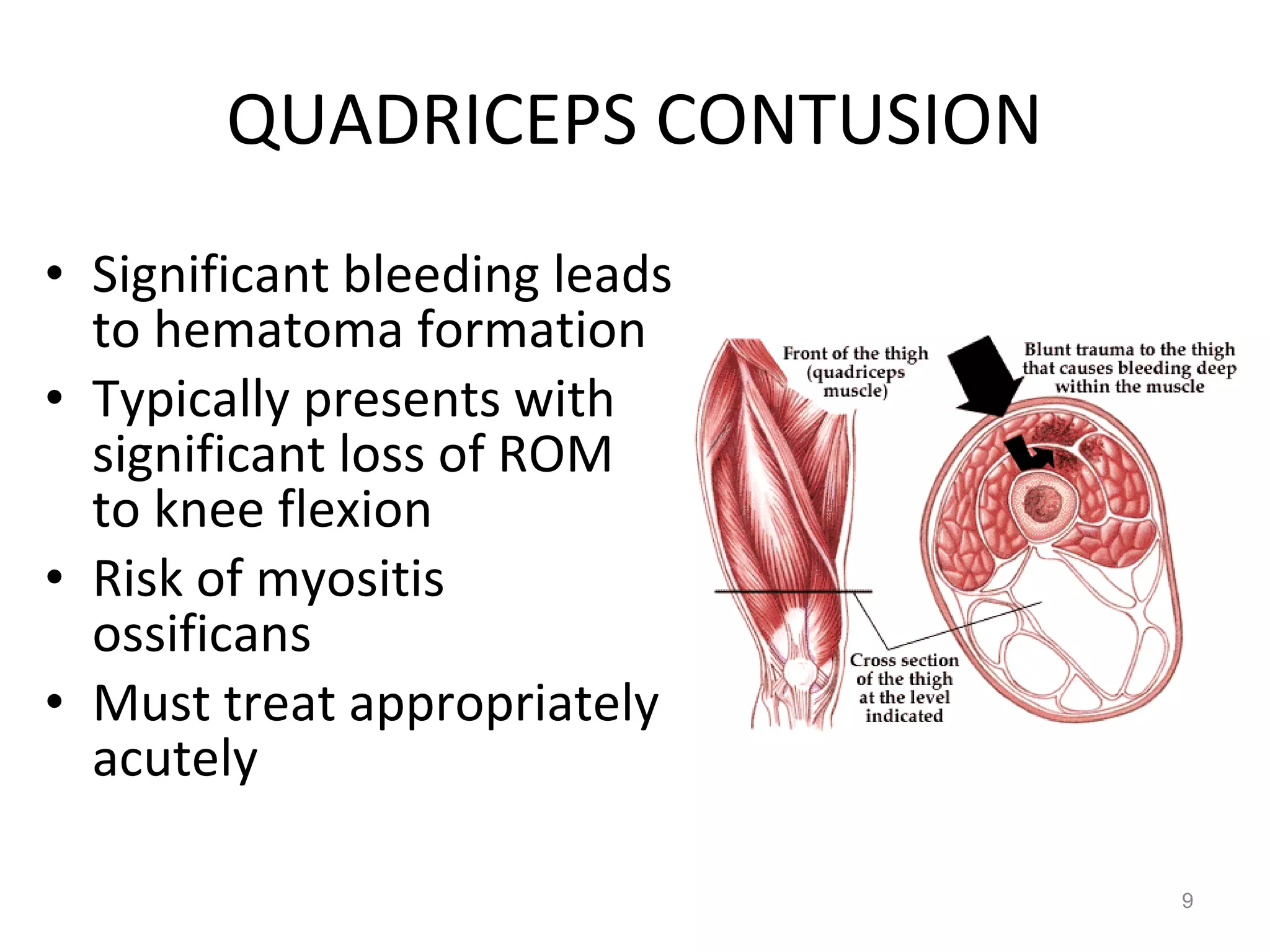 QUADRICEPS CONTUSION Significant bleeding leads to hematoma formation Typically presents with significant loss of ROM to knee flexion Risk of myositis ossificans Must treat appropriately acutely 