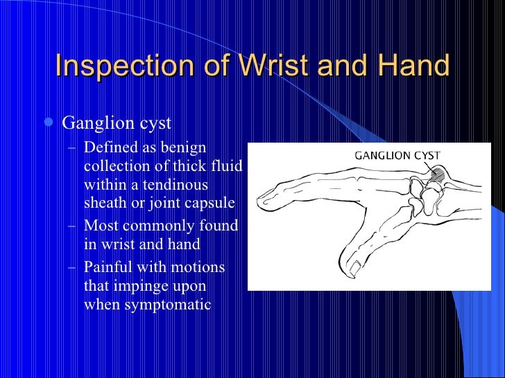 Quality porn - Cyst ulner styloid thumb removal styloid thumb removal Cyst ulner