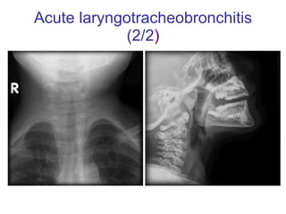 Acute laryngotracheobronchitis (2/2 ) 