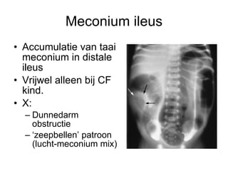 Meconium ileus Accumulatie van taai meconium in distale ileus Vrijwel alleen bij CF kind.  X:  Dunnedarm obstructie ‘ zeepbellen’ patroon (lucht-meconium mix) 