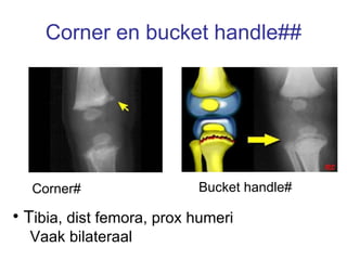 Corner en bucket handle## Corner# Bucket handle# T ibia, dist femora, prox humeri Vaak bilateraal 