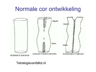Normale cor ontwikkeling Tetralogievanfallot.nl 