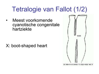 Tetralogie van Fallot (1/2) Meest voorkomende cyanotische congenitale hartziekte X: boot-shaped heart 
