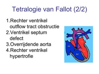 Tetralogie van Fallot (2/2) Rechter ventrikel outflow tract obstructie Ventrikel septum defect Overrijdende aorta Rechter ventrikel hypertrofie 
