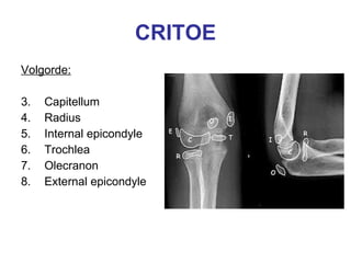 CRITOE Volgorde: Capitellum Radius Internal epicondyle Trochlea Olecranon External epicondyle 