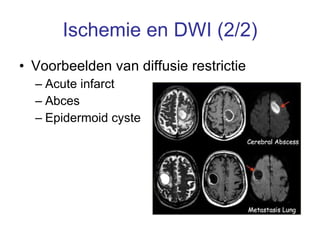 Ischemie en DWI (2/2) Voorbeelden van diffusie restrictie Acute infarct  Abces Epidermoid cyste 