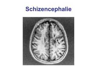 Schizencephalie 