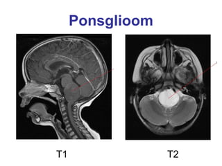 Ponsglioom T1   T2 
