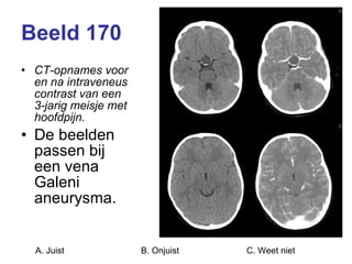 Beeld 170 CT-opnames voor en na intraveneus contrast van een 3-jarig meisje met hoofdpijn. De beelden passen bij een vena Galeni aneurysma. A. Juist B. Onjuist C. Weet niet  