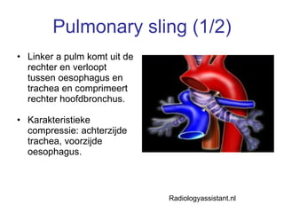 Pulmonary sling (1/2) Linker a pulm komt uit de rechter en verloopt tussen oesophagus en trachea en comprimeert rechter hoofdbronchus. Karakteristieke compressie: achterzijde trachea, voorzijde oesophagus. Radiologyassistant.nl 