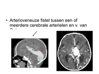 Arterioveneuze fistel tussen een of meerdere cerebrale arterielen en v. van Galen 