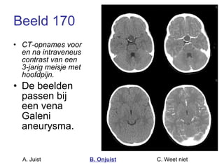 Beeld 170 CT-opnames voor en na intraveneus contrast van een 3-jarig meisje met hoofdpijn. De beelden passen bij een vena Galeni aneurysma. A. Juist B. Onjuist C. Weet niet  