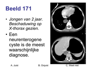 Beeld 171 Jongen van 2 jaar. Beschaduwing op X-thorax gezien. Een neurenterogene cyste is de meest waarschijnlijke diagnose. A. Juist B. Onjuist C. Weet niet  