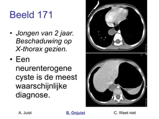 Beeld 171 Jongen van 2 jaar. Beschaduwing op X-thorax gezien. Een neurenterogene cyste is de meest waarschijnlijke diagnose. A. Juist B. Onjuist C. Weet niet  