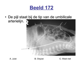 Beeld 172 De pijl staat bij de tip van de umbilicale arterielijn. A. Juist B. Onjuist C. Weet niet  