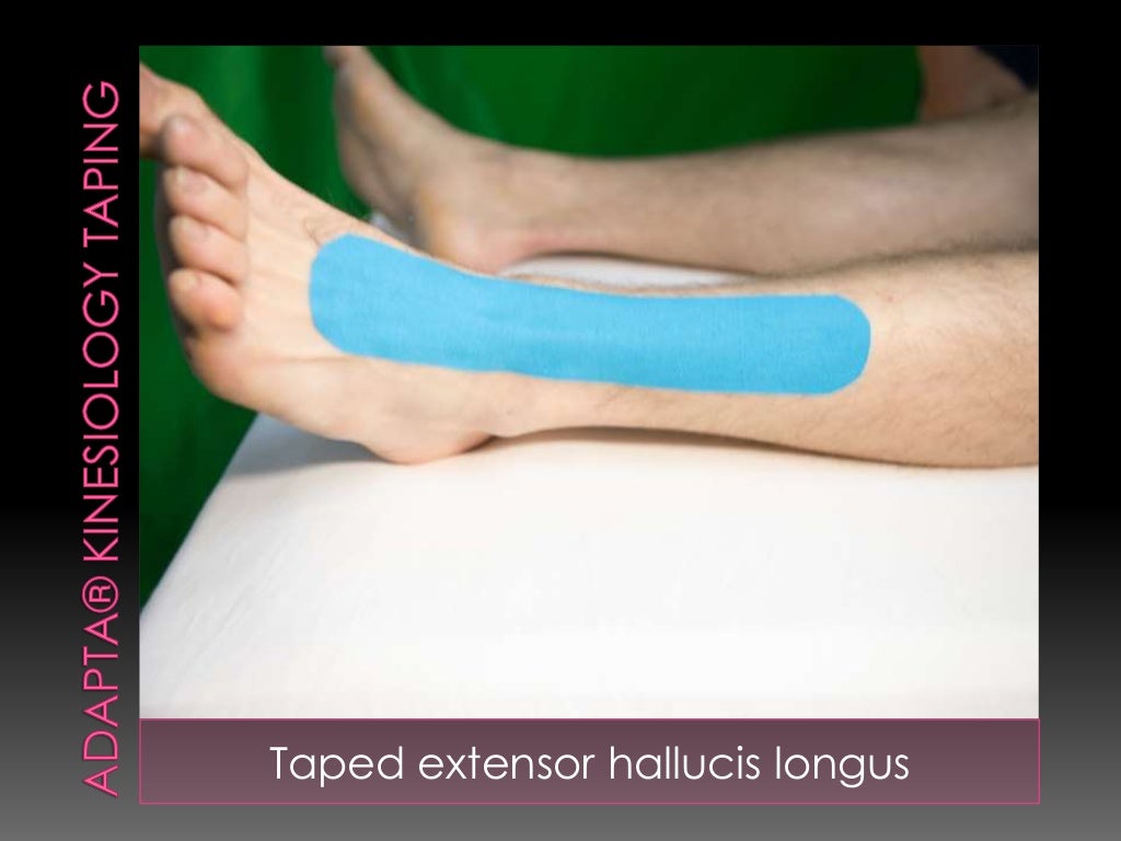 Kinesiology Taping Hallucis Longus